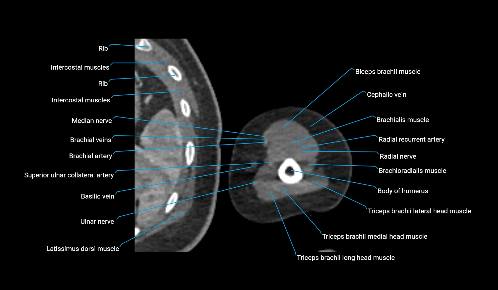 CT upper arm axial  cross sectional anatomy labelled radiology image -00312.webp